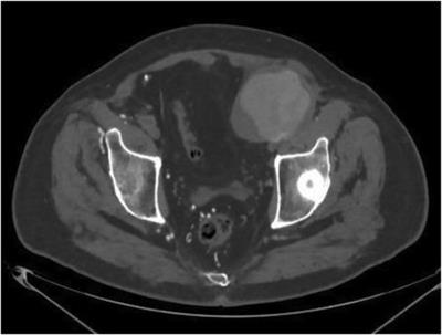 Case Report: False aneurysm as a late unusual complication of the aortofemoral bypass graft in a patient with critical leg ischemic symptoms: interesting case